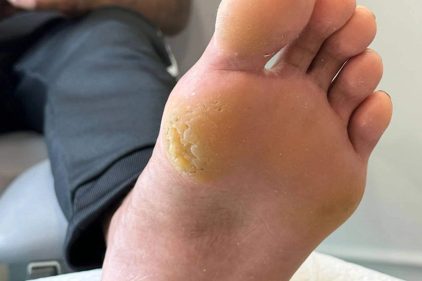Painful foot callus under the left big toe joint