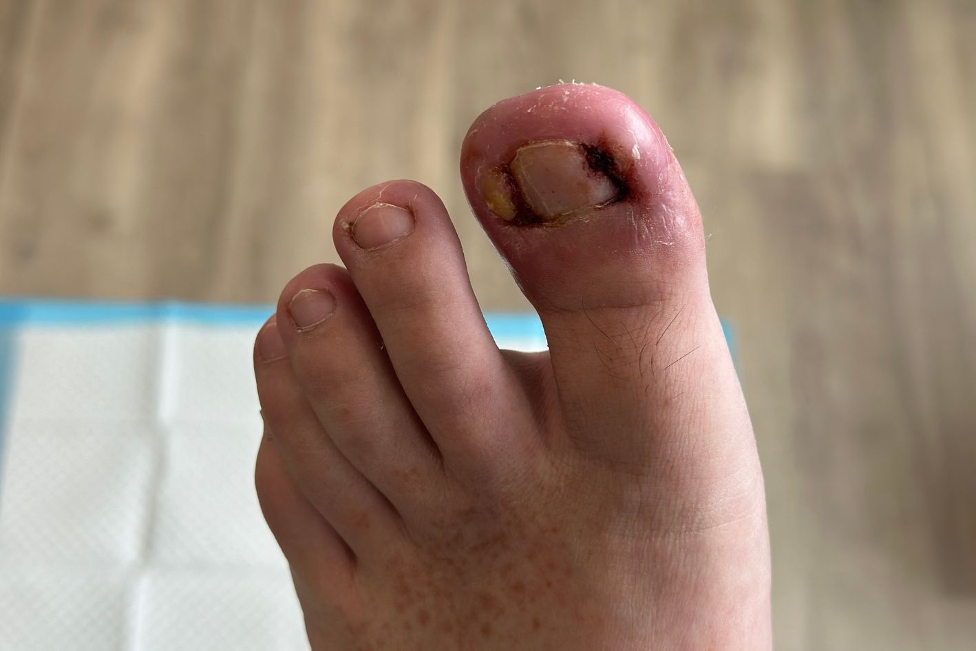 Patient with left big toe recurring infected ingrown toenail