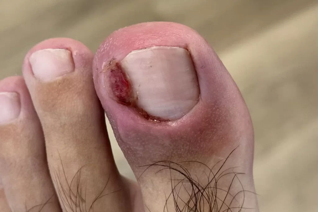 Paronychia of the left big toe due to underlying ingrown toenail